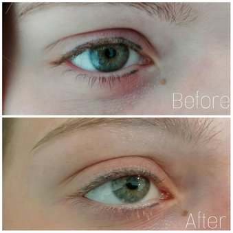 Voor- en na foto Phi Removal mislukte eyeliner